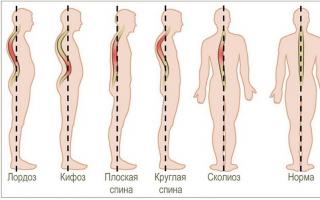 Grader av skolios i ryggraden och deras huvudsakliga egenskaper Lumbal-thorax skolios 2 grader