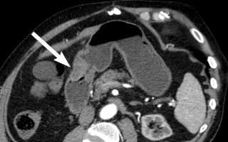 Alin ang mas mahusay: MRI o CT scan ng cavity ng tiyan - mga diagnostic na tampok
